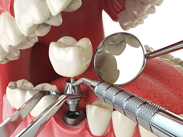 Best Emergency Dentist for Lost Fillings or Crowns in Portland, MI